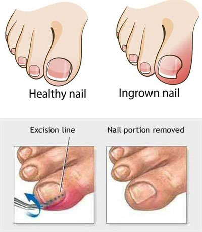 Partial Nail Avulsion (Ingrown Toenail Removal Treatment) – EC Orthotics